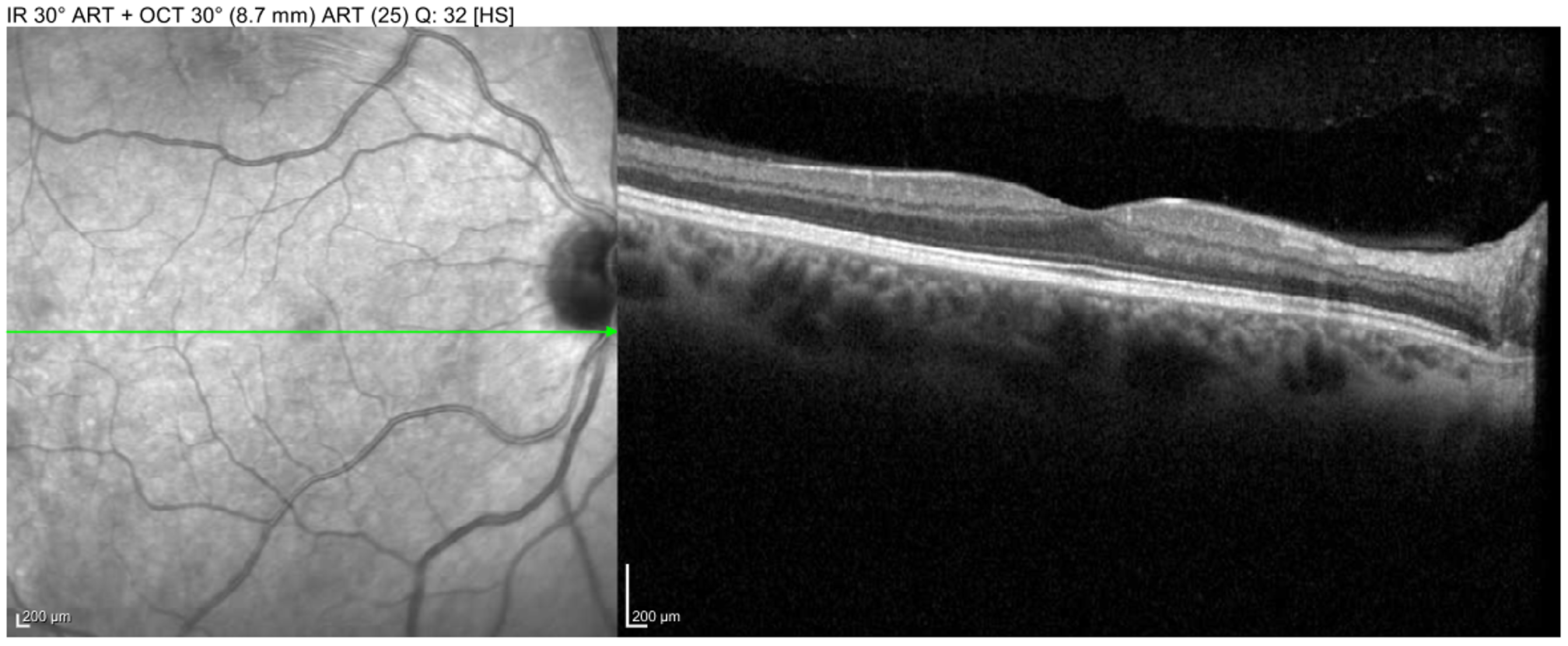 Macula OCT of the right eye showing a small superior BRAO visible on near-infrared en-face image.