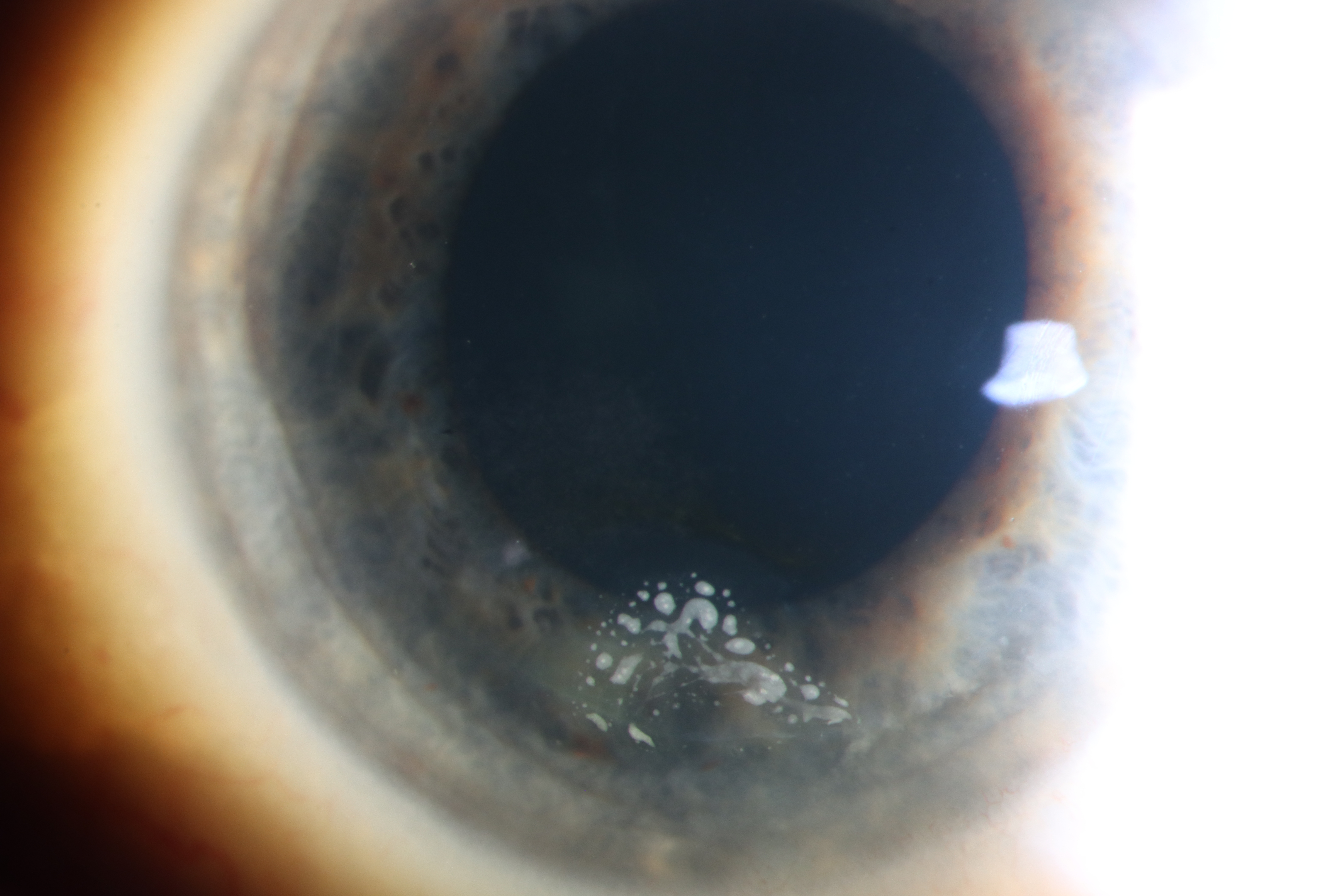 Sclerotic scatter slit lamp photograph showing triangular deposition of epithelial cells underneath LASIK flap.