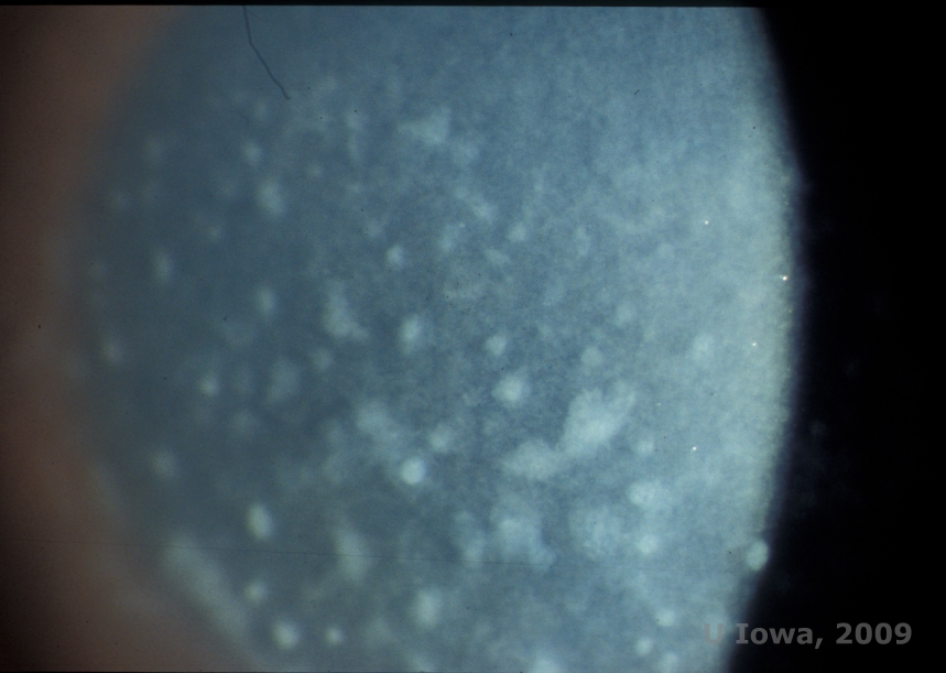 Macular Corneal Dystrophy