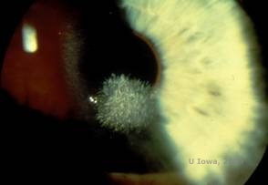 Corneal stromal dystrophies: Macular, Granular, Lattice dystrophy of cornea