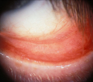 chlamydia in eye