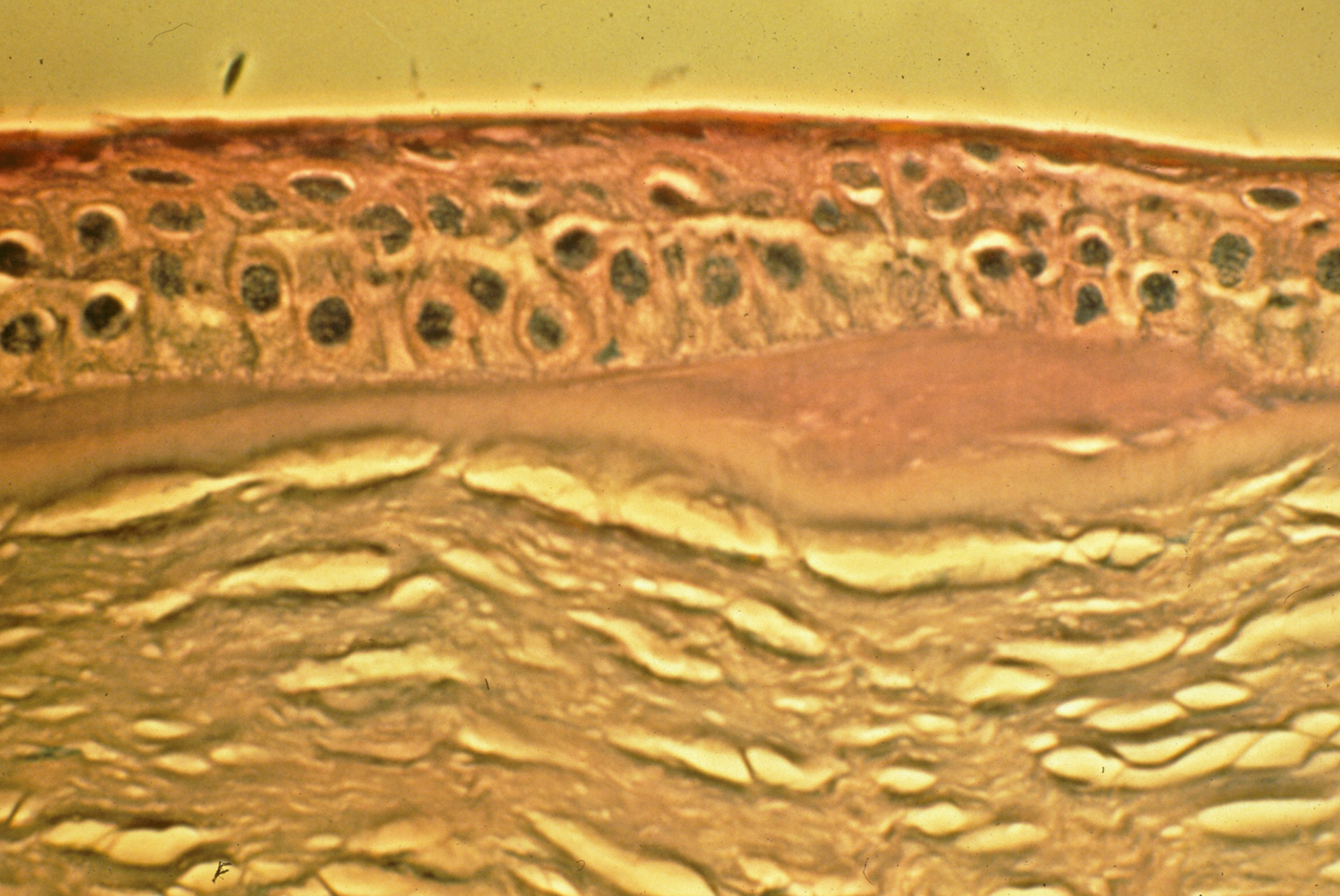 treatment-of-epithelial-basement-membrane-dystrophy-with-manual