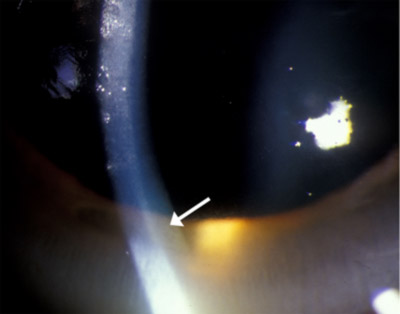 Foto de mayor aumento del anillo marrón dorado a nivel de la membrana de Descemet's membrane