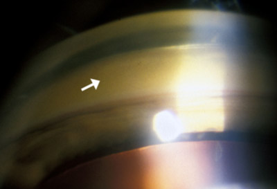 a szög onioszkópiája, aranybarna lerakódást mutat a Descemet membránjában's membrane