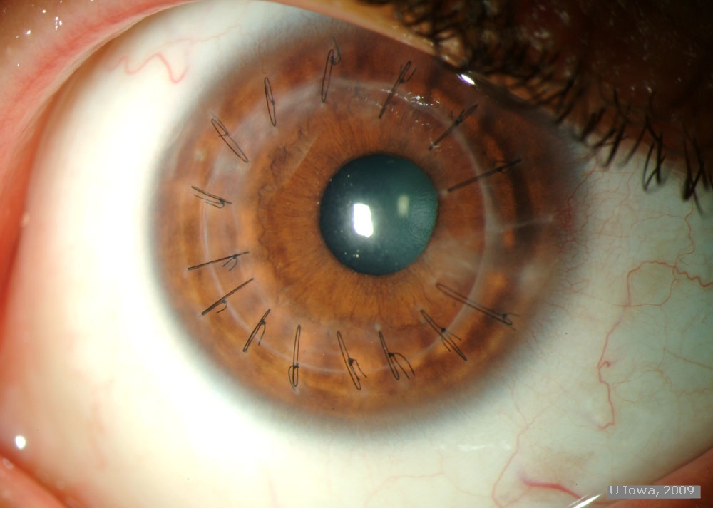 Corneal Surgery For Keratoconus At Valeria Sturm Blog