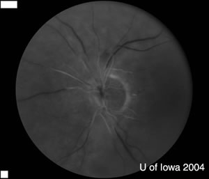 Cherry-Red Spot in Tay–Sachs Disease