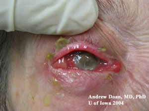 cellulitis purulent endophthalmitis orbital eye discharge eyerounds right od injection pan conjunctival bacterial proptosis face hypopyon anterior chamber periorbital cases