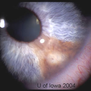 Iris melanooma
