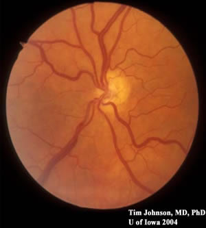 Related Case: Optic Nerve Hypoplasia