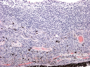 pathologie van Irismelanoom