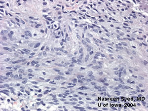 patologi av Iris melanom