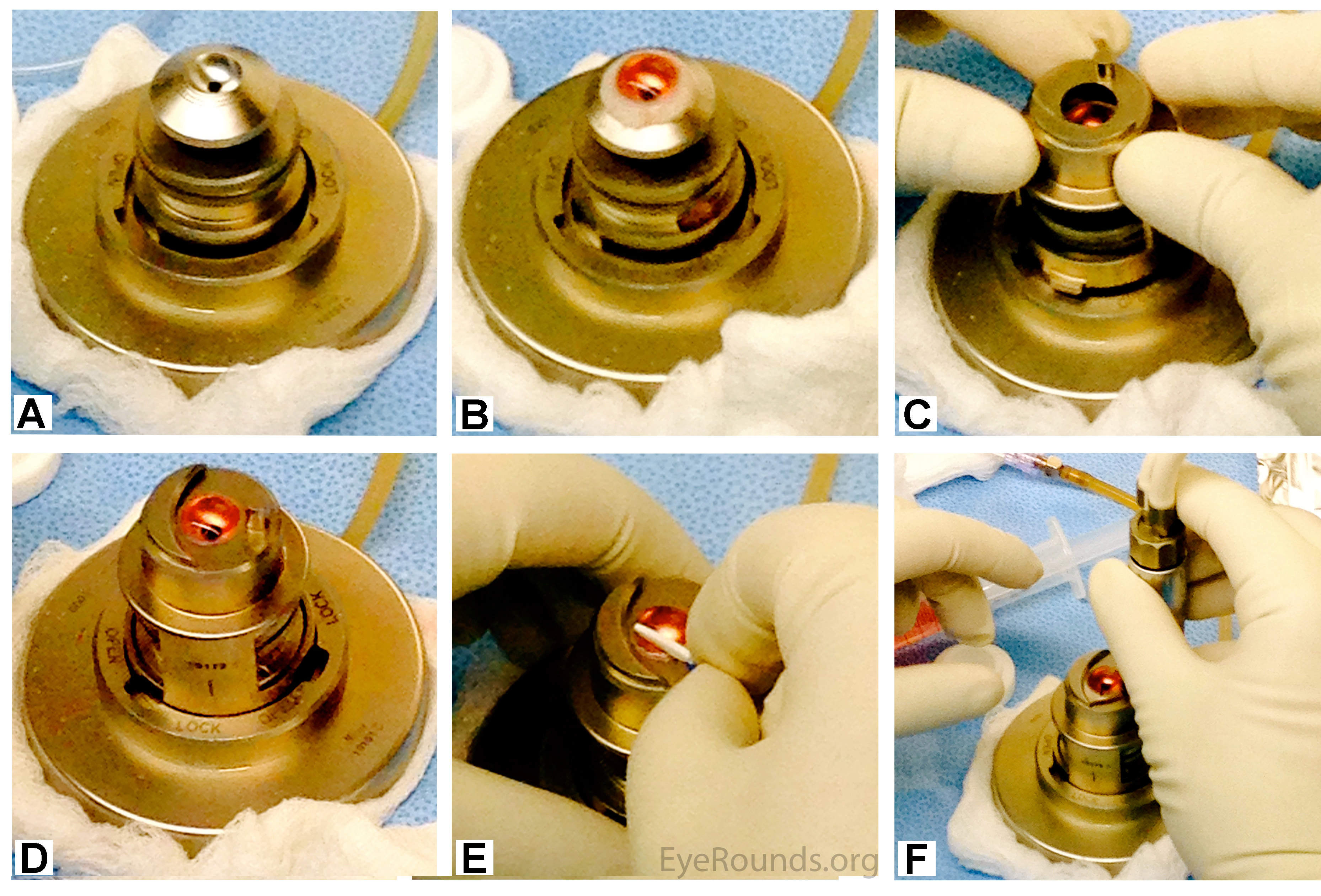 Panel showing the preparation of a cornea for Descemet stripping automated endothelial keratoplasty (DSAEK)