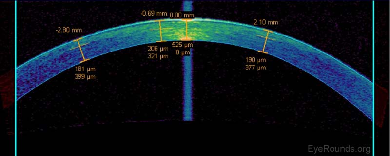  Abbildung 11. Messung des verbleibenden Strombetts unter einem LASIK-Lappen auf AS-OCT. Die zentrale Hornhautdicke wird auf 525 µm geschätzt, und das verbleibende Strombett wird auf 321 µm zentral und 377-399 µm in Richtung der peripheren Hornhaut gemessen. An der University of Iowa gilt ein Patient als kein Kandidat für LASIK oder Enhancement, wenn das endgültig berechnete Reststrombett weniger als 300 µm beträgt.