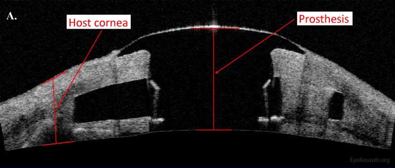 Figura 13a. Dispositivo di cheratoprotesi Boston di tipo I esaminato utilizzando AS-OCT