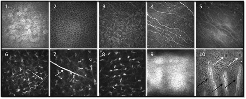 figur 14. Konfokal mikroskopi avbildning av de olika hornhinneskikten med laserskanning in vivo konfokal teknik. 1-3. Ytligt epitel, epitelial vingcellskikt och basalt epitel; 4. Subbasal nervplexus; 5. Bowmans lager; 6-8. anterior stroma med nerv (pil), mittstroma med nervstam (pil) och bakre stroma; 9. Endotel; och 10. Sämre limbal palisade åsar (svarta pilar) med fokala stromala utsprång (vita pilar). Bild med tillstånd av Dr. Neil Lagali(länk 21). 