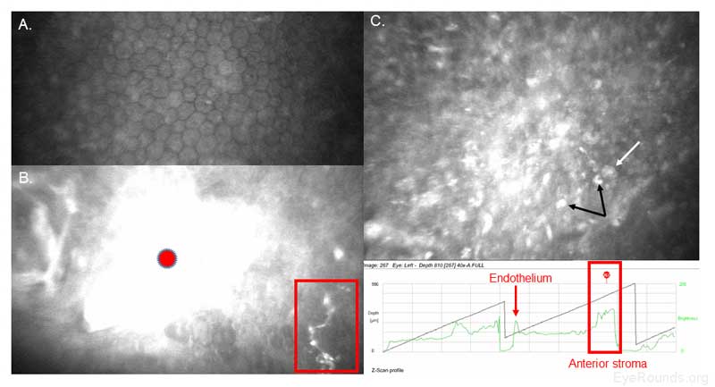  obrázek 19. Konfokální mikroskopie detekce Acanthamoeba a houbové keratitidy u uživatele kontaktních čoček. A. Endoteliální polymegatismus, který je známkou stresu rohovky, je pravděpodobně výsledkem dlouhodobého používání kontaktních čoček pacienta. V endotelové vrstvě nejsou přítomny žádné cysty ani trofozoity. B. nábor bílých krvinek (červený kruh) je patrný v přední stromě přímo sousedící s cysty Acanthamoeba (bílá šipka) a houbovými prvky (červený rámeček). Acanthamoeba trophozoites se živí hyfy, pokud obě infekce nejsou okamžitě léčeny. C. Acanthamoeba dvoustěnné cysty (bílá šipka) a trofozoity (černé šipky) jsou přítomny v celé přední stromě. Z-profil skenování líčí zpětný rozptyl (tj. jas jednotlivých konfokální skenování), který umožňuje rychlé posouzení rohovky umístění (červená pole) a hustota buněk v konkrétní oblasti. 