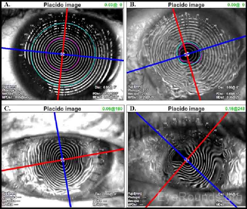  Figura 2. Proyección de ciénagas de disco plácidas en (A) una córnea normal con ciénagas crujientes y astigmatismo mínimo, (B) una córnea con sequedad superficial, (C) una córnea con astigmatismo regular contrario a la regla dentro de un trasplante de córnea de espesor completo, y (D) una córnea con astigmatismo irregular dentro de un trasplante de córnea de espesor completo. Las imágenes de Plácido pueden ayudar a guiar la eliminación selectiva de suturas; por ejemplo, las suturas en (C) se podrían quitar a las 3 y a las 9, si el curso clínico lo permite, para reducir el astigmatismo postoperatorio. 