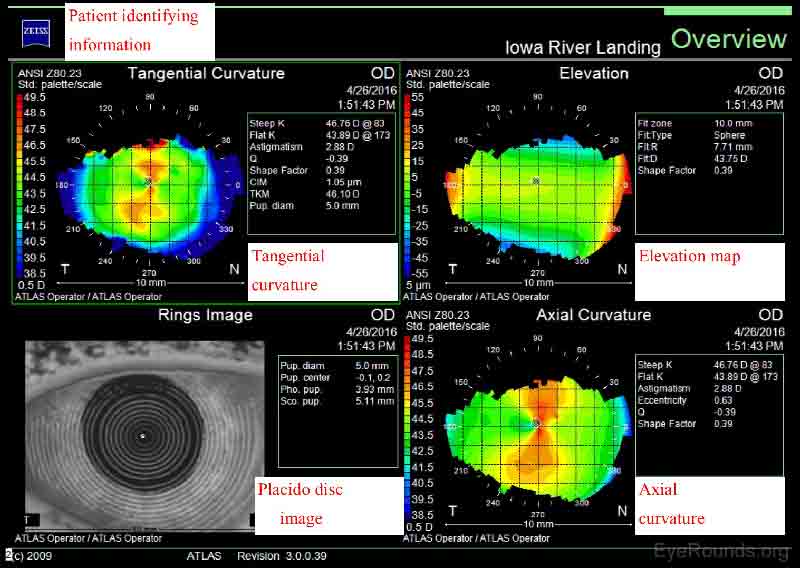  Figur 3. Zeiss Atlas Report. De tangentielle og aksiale krumningskartene viser begge med-regelen hornhinnen astigmatisme med mer pluss kraft i den vertikale meridianen. Spesielt er den bratteste meridianen på 083 grader, og det er 2,88 dioptre av astigmatisme. Placido disc-bildet viser vanlige, konsentriske myrer, noe som indikerer en sunn hornhinneoverflate. 