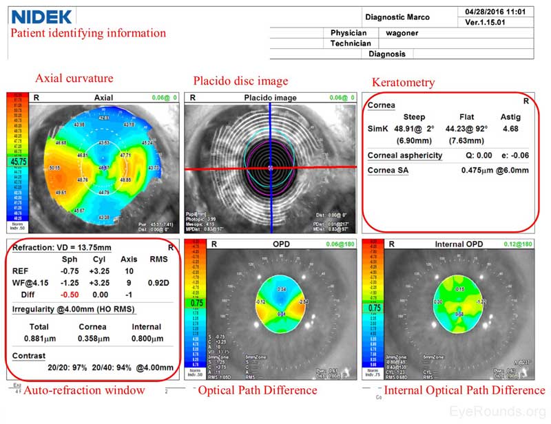 Figura 4. Relatório NIDEK. Painéis superiores: O mapa da curvatura axial mostra astigmatismo corneal com mais poder no meridiano horizontal. A imagem do disco Placido mostra miros concêntricos com alguma irregularidade na região inferonasal da córnea. O meridiano mais íngreme está a 002 graus, e há 4,68 diopters de astigmatismo. Pães inferiores: tanto as medições da auto-acção (REF) como da frente de onda (WF) estimam o doente com miopia ligeira (- 0,75 a-0,25) com correcção astigmatismo significativa (+3,25) no meridiano horizontal (009 A 010 graus). O erro de refração total é estimado usando a diferença do caminho óptico (OPD) para ser -0,75 diopters com +3,25 de astigmatismo no eixo 010.