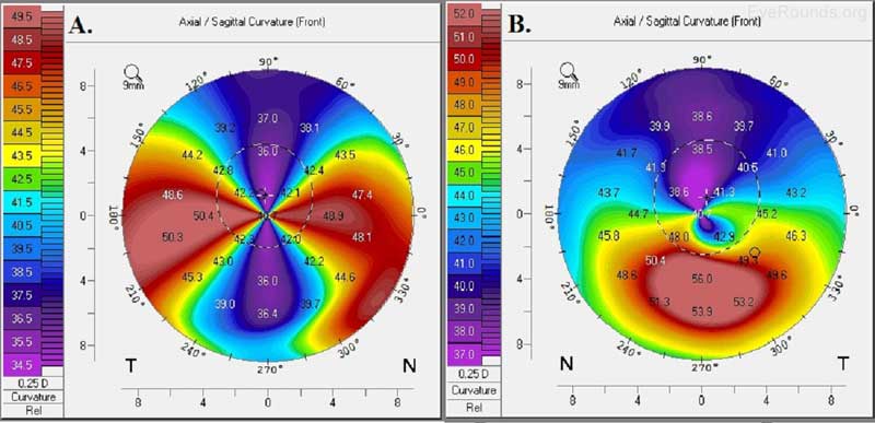 Gráfico 6 Degeneración corneal marginal pelúcida (A) y queratoncono (B). Los mapas axiales anteriores generados con tecnología Oculus Pentacam muestran el astigmatismo alto contra la regla en un patrón de" garra de cangrejo " de degeneración corneal marginal pelúcida y el patrón de empinamiento inferior del queratoncono. 