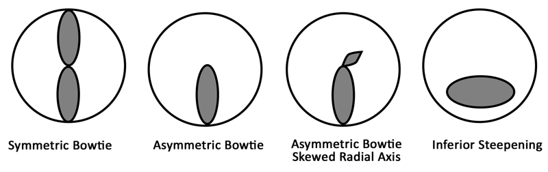 Abbildung 7. Fortschreiten des Keratokonus. Häufig zeigt die Topographie das Fortschreiten des Keratokonus von symmetrischem Astigmatismus zu asymmetrischem Astigmatismus, gefolgt von einem asymmetrischen Astigmatismusmuster mit einer schiefen Radialachse. Bei fortschreitendem Keratokonus kann sich letztendlich eine minderwertige Steilheit entwickeln. 