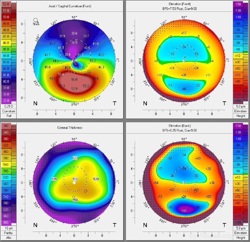  figura 8. Keratoconus pe Pentacam. Harta axială anterioară prezintă o abrupție paracentrală inferioară semnificativă, în timp ce harta pachimetrică arată subțierea în zona abruptului. Flotoarele anterioare și posterioare dezvăluie o umflătură paracentrală, ceea ce sugerează o înălțime focală în comparație cu o suprafață ideală, sferică.