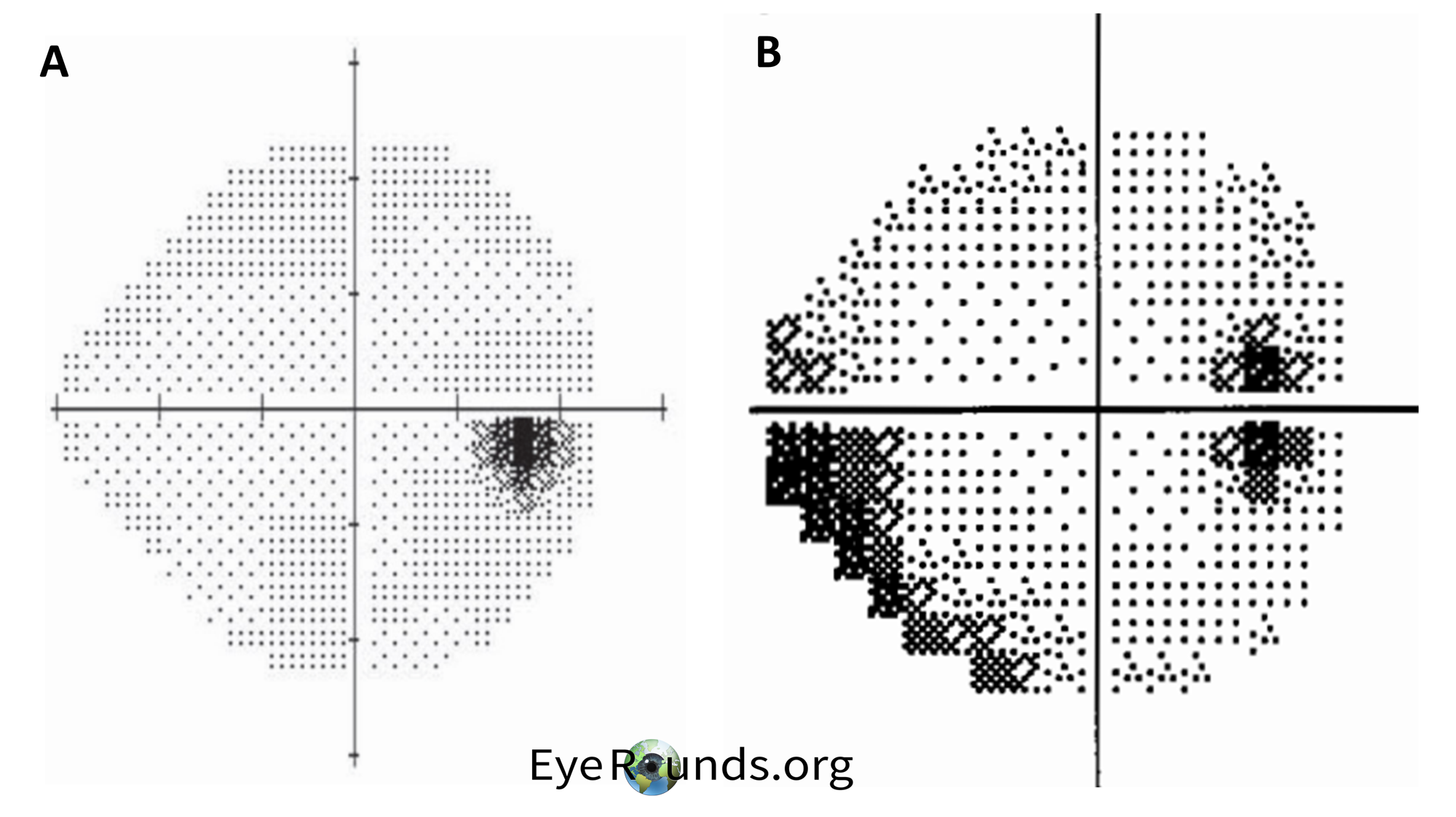 normal visual field vs blind spot and partial inferior arcuate defect