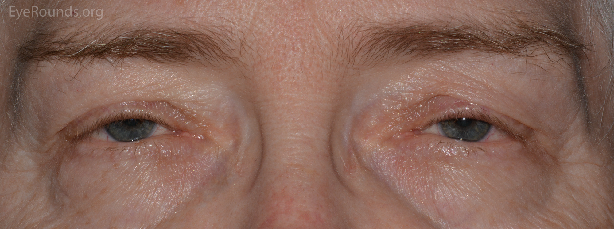 upper eyelid ptosis