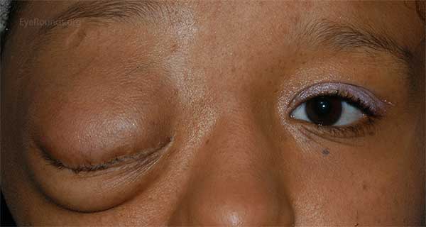 A Primer On Ptosis