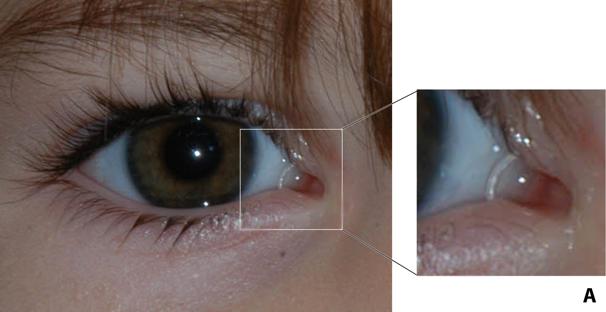 eye-anatomy-lacrimal-gland-function-and-dry-eye