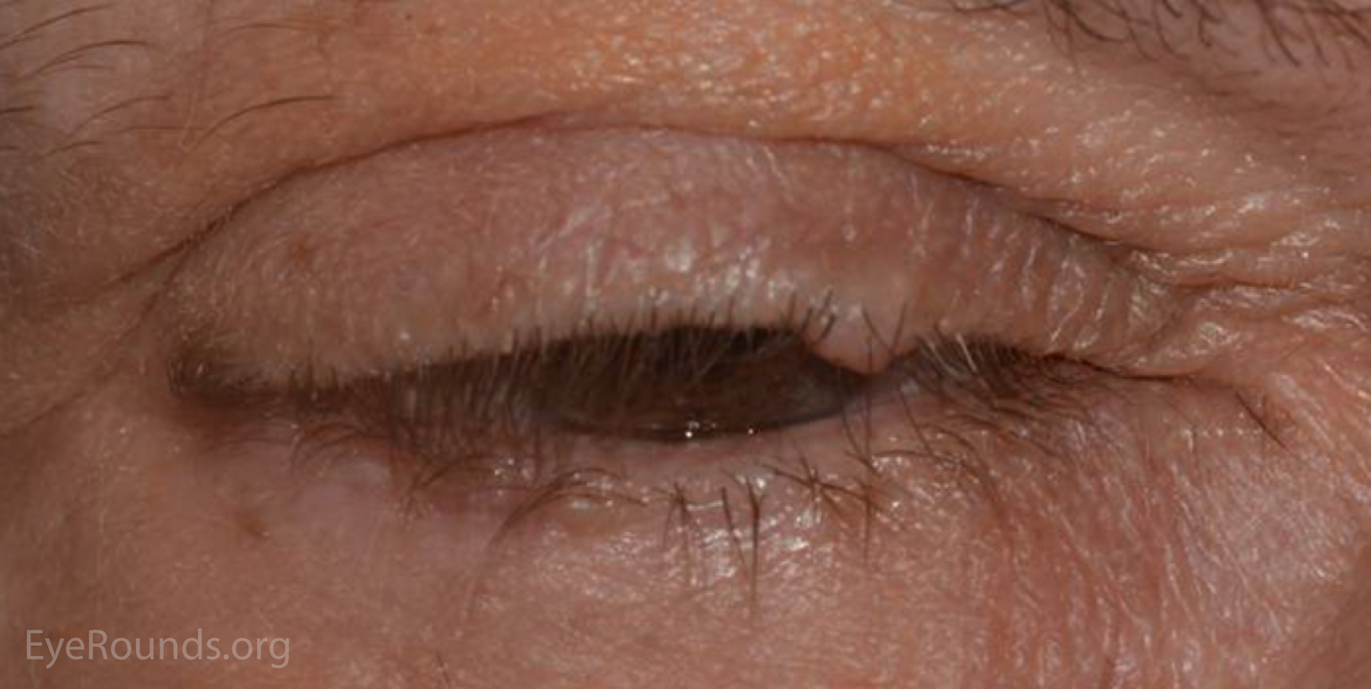 Bump On Eyelid Near Lash Line Find Out How To Distinguish Between