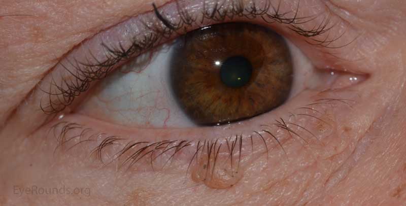 verruca vulgaris eyelid