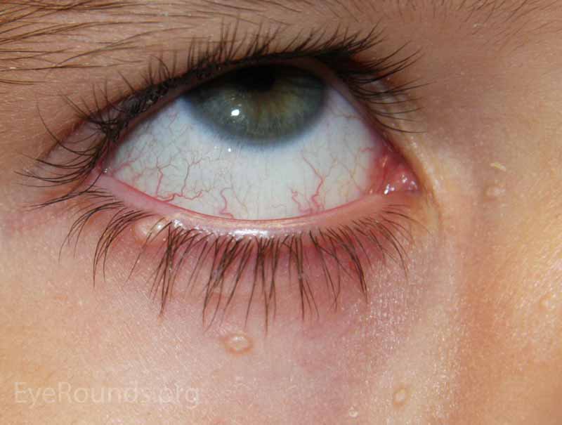 Benign Eyelid and Eye Growths > Fact Sheets > Yale Medicine