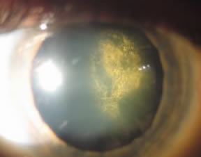 Posterior Subcapsular cataract