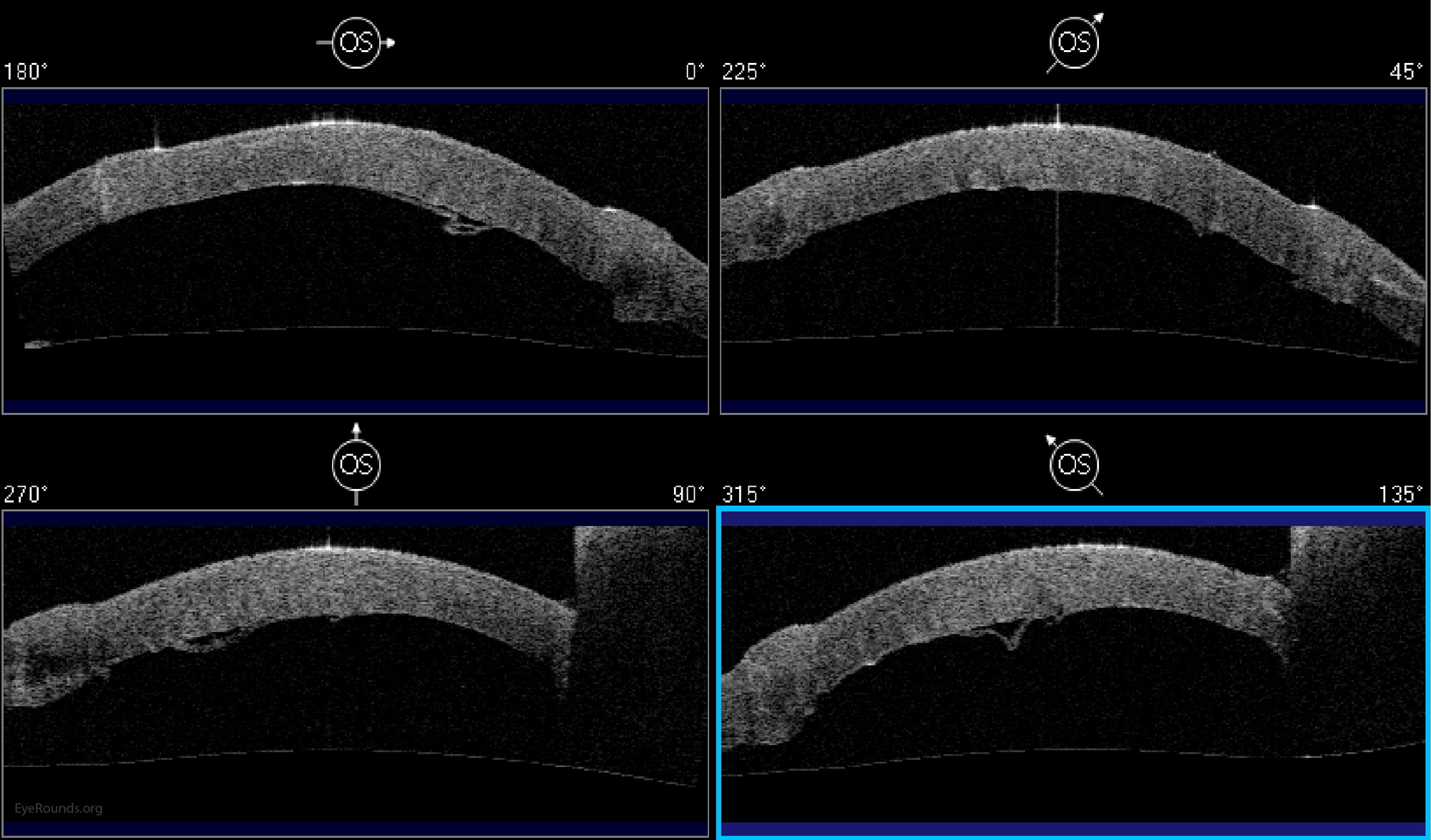  Anterior segment optical coherence tomography