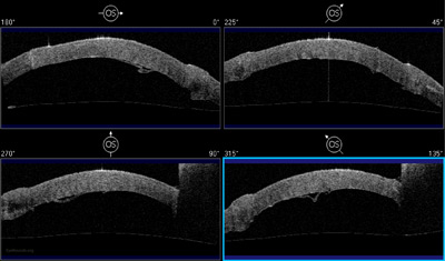 Fig 7a: Anterior segment optical coherence tomography demonstrating the redundant host Descemet membrane and endothelium in poor apposition to the graft tissue