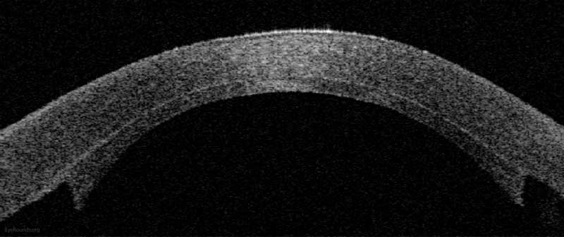 Anterior segment optical coherence tomography demonstrating an attached DSAEK graft one day after surgery.