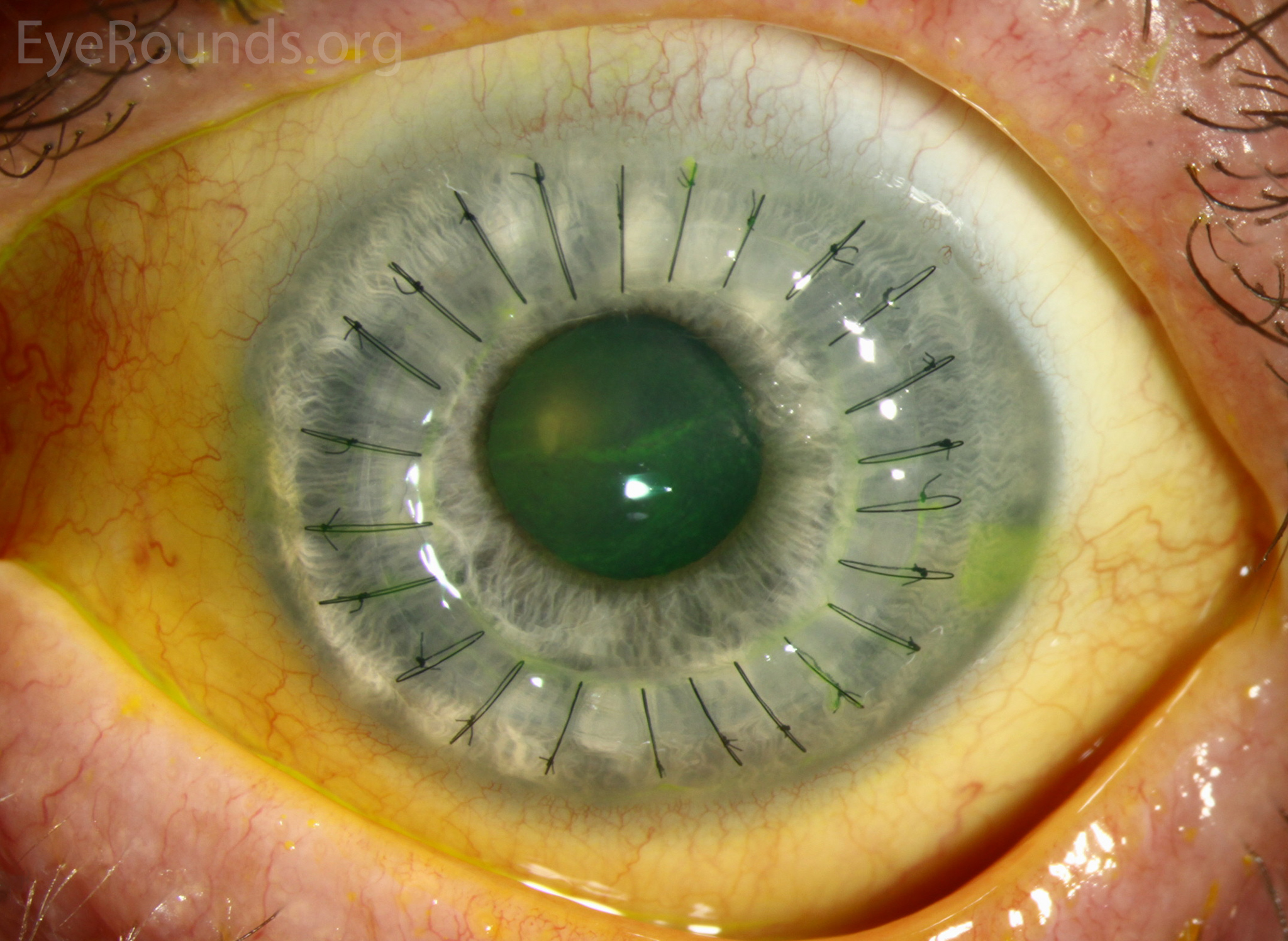 An Introduction To Corneal Transplantation