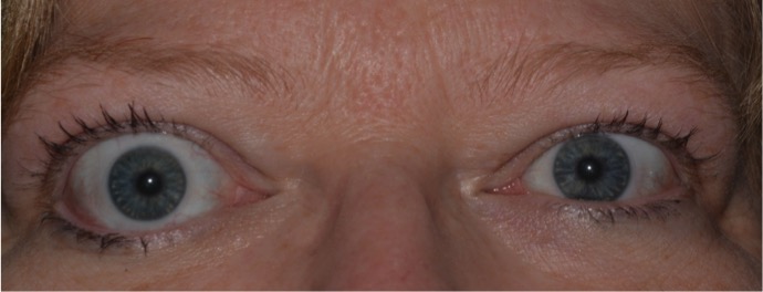   Eyelid retraction is the most common presenting sign of TED.