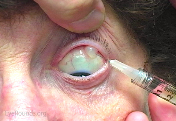 Subconjunctival injection 