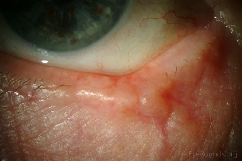 Basal Cell Carcinoma Eyelid