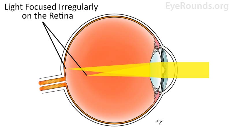 An astigmatic eye has an unevenly shaped cornea causing both close and distant objects to appear blurry.