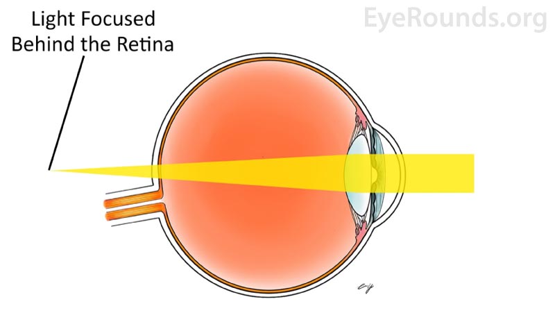 In hyperopia, the eye is too short or the cornea is too flat. As a generalization, close objects appear blurry because images are focused behind the retina. 