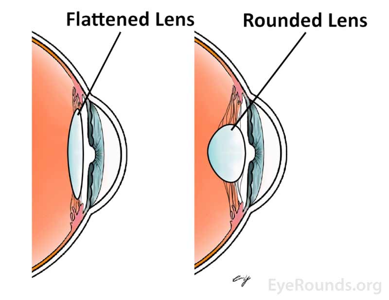 Shape of an accommodated lens (right) and a non-accommodated lens (left), exaggerated here to highlight the changes during accommodation. 