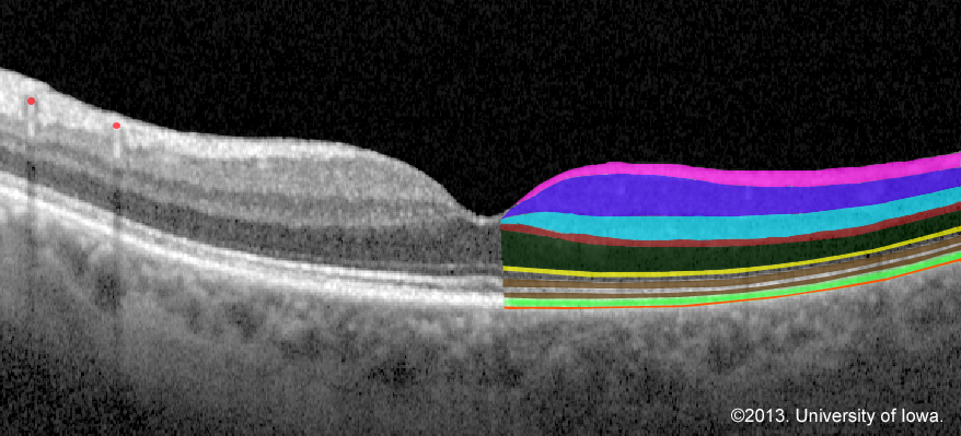 Retinal Detachment From One Medical Student To Another