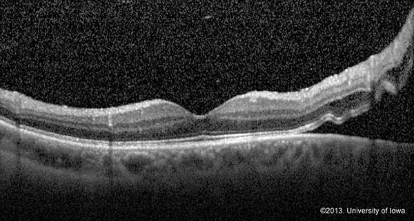 rhegmatogenous retinal detachment oct