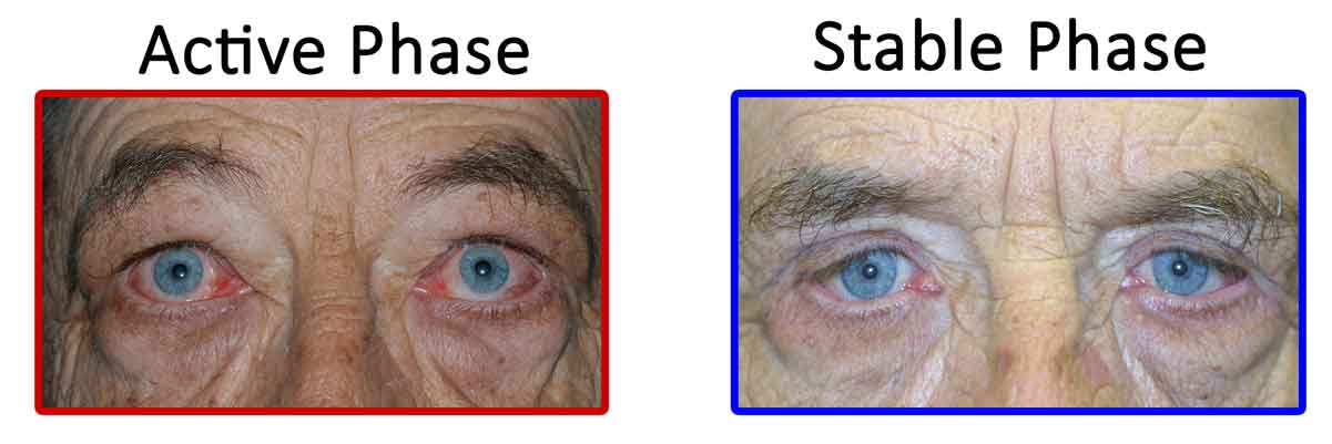 Active vs. Stable TED. Active TED is characterized by signs of inflammation (orbital muscle enlargement, conjunctival injection, swelling of periocular tissue, and chemosis). TED activity waxes and wanes, and usually transitions to stable TED within 1-3 years.