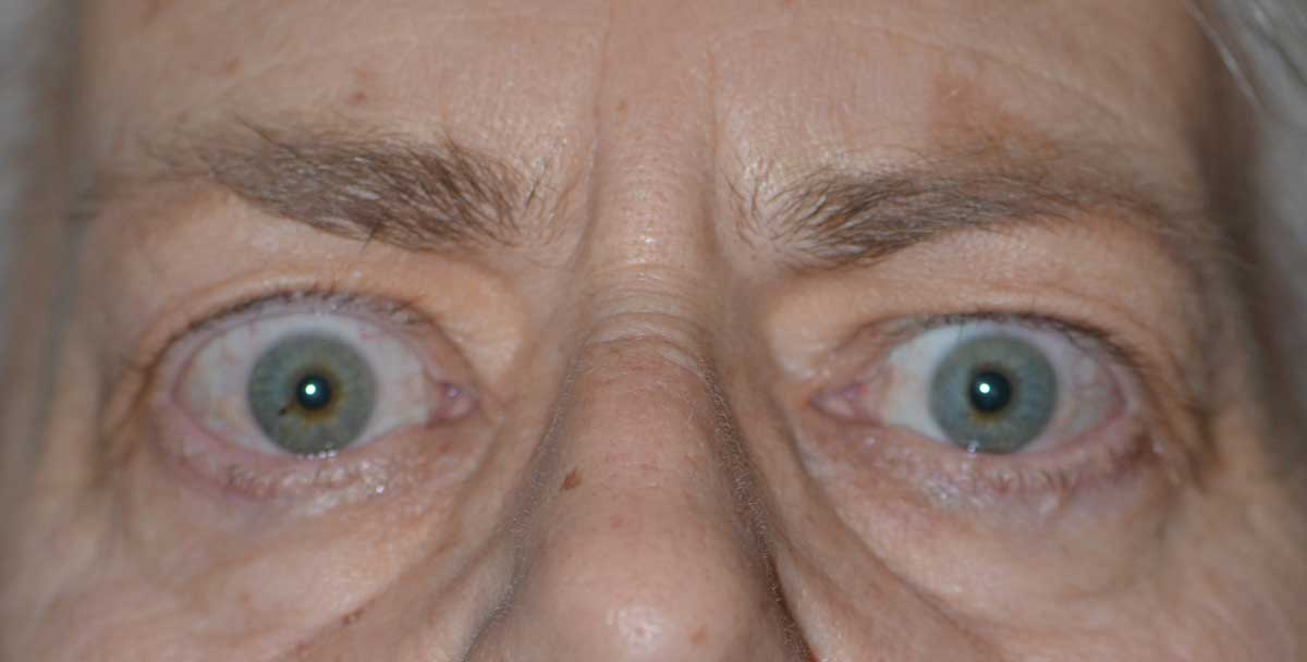 Temporal flare. Note the elevation of the temporal portion of the upper eyelid.
