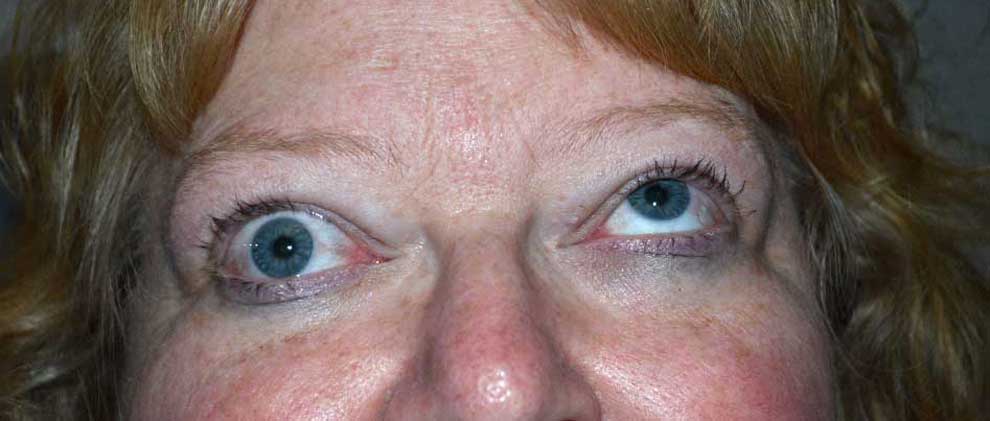 Hypotropia. Note the vertical misalignment of the eyes in primary gaze and the restrictive movement in upward gaze. This is due to an enlarged and restricted inferior rectus muscle.