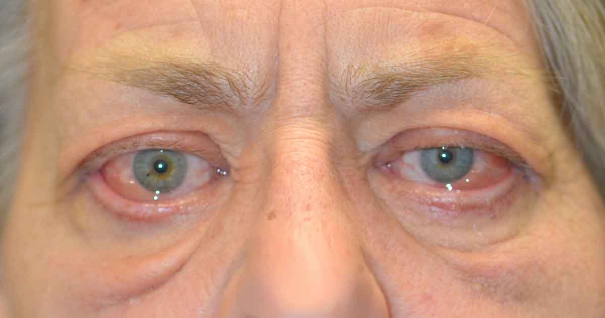 Chemosis. Note the swelling within the conjunctiva